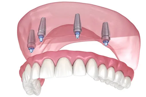 Implant supported dentures