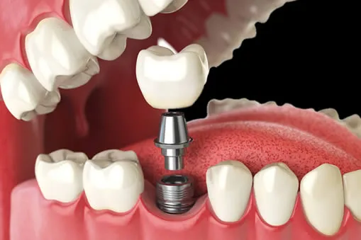 single tooth dental implant